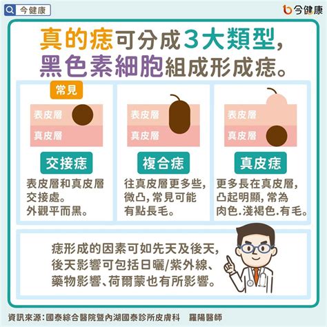 頭上有肉痣|是痣or皮膚癌？醫「1張圖秒對照」 長這2部位最危險